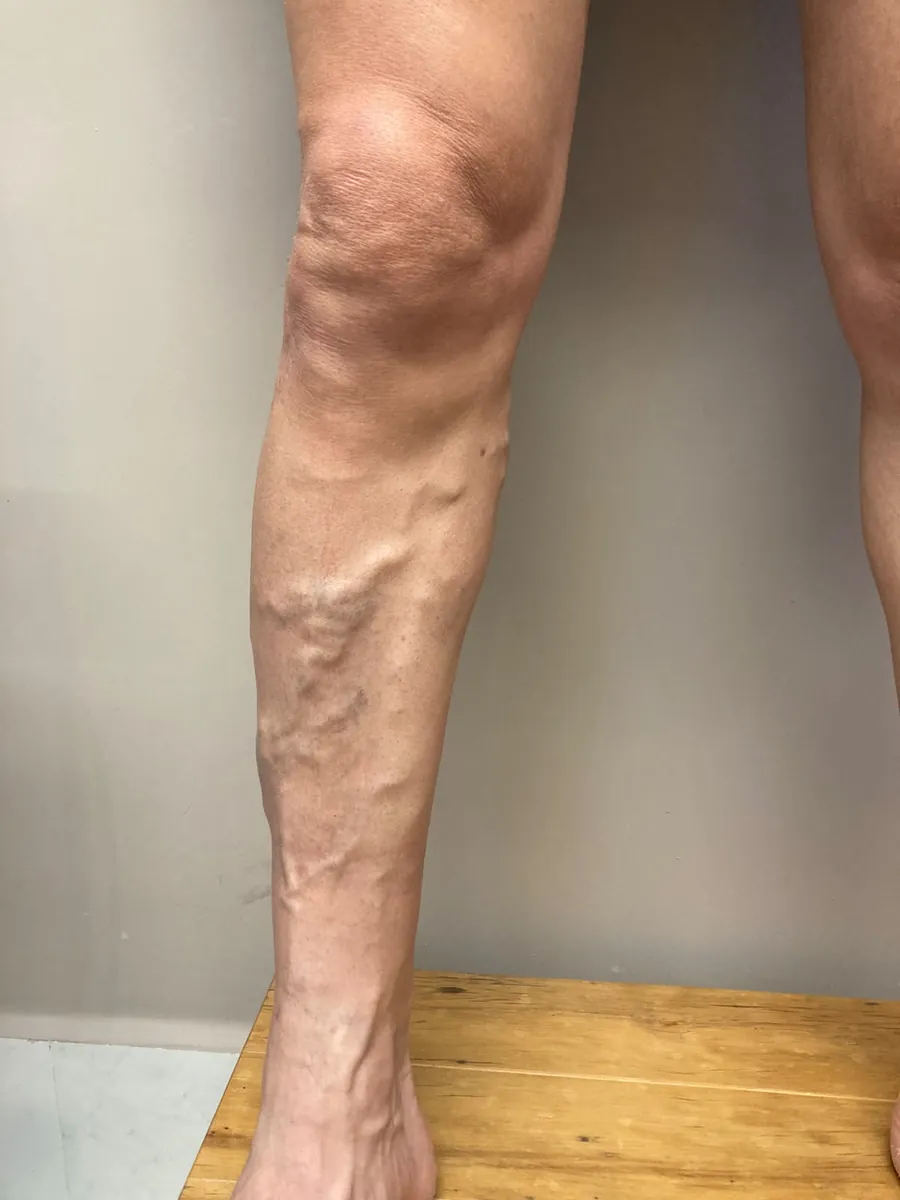 Perna com varizes calibrosas visíveis na panturrilha, antes da avaliação vascular