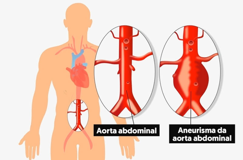 Riscos de ruptura de um Aneurisma de Aorta Abdominal. | Dra. Giovanna Guarinello