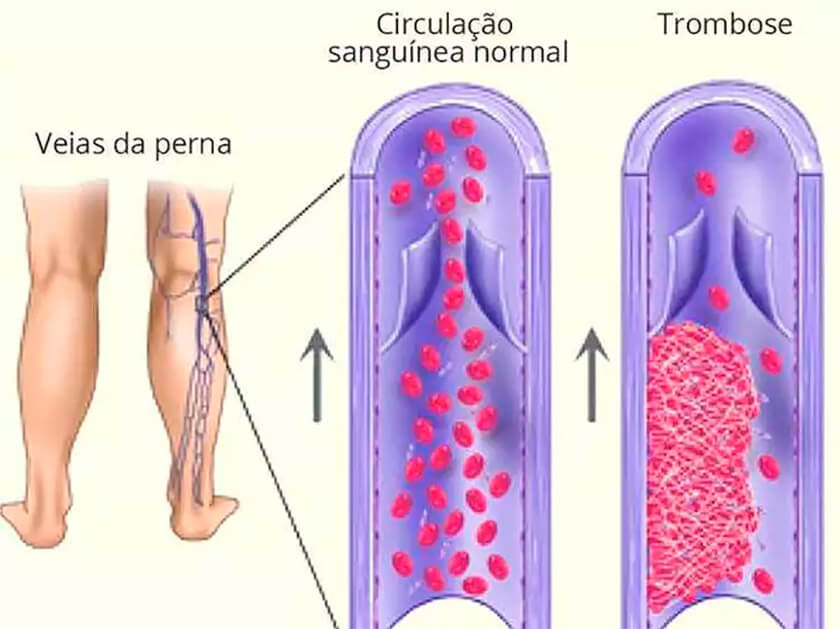 Os sintomas da Trombose.