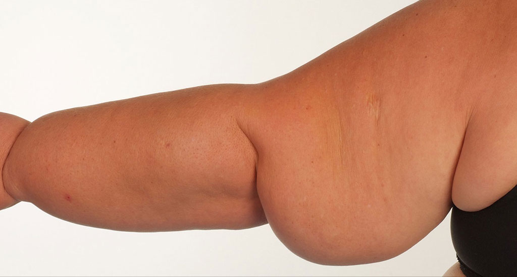 Linfedema