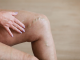 <strong>Varizes podem se romper? Conheça a Varicorragia</strong> | Dra. Giovanna Guarinello